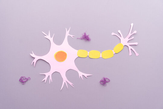 Alzheimer's disease brain. Nerve cell in neurodegenerative disease with amyloid plaques made from paper on violet background.
