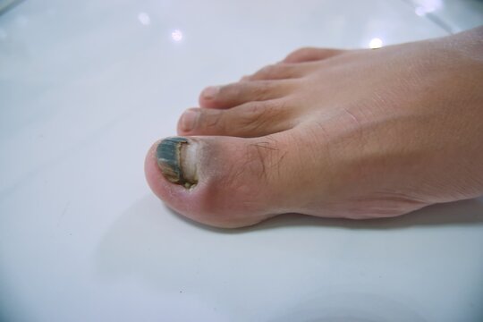 Detailed Close-up of Injured and Discolored Toenail of the Human Foot