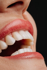 Macro closeup of perfect white porcelain veneers with glossy coral lipstick smile