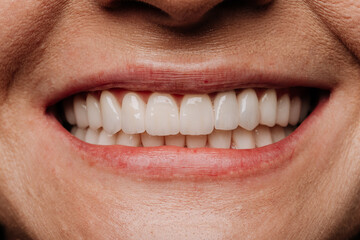 Obraz premium Closeup mature smile with natural white veneers and healthy teeth dental aesthetics