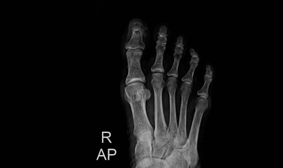 Foot X-ray showing metatarsals, phalanges and tarsal bones in anteroposterior view. Medical...