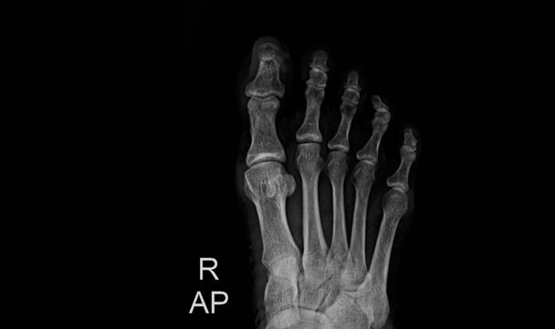 Foot X-ray showing metatarsals, phalanges and tarsal bones in anteroposterior view. Medical diagnostic imaging for orthopedic evaluation, fracture detection and foot skeletal structure assessment.