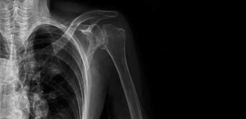 Shoulder X-ray showing humerus, scapula, clavicle and upper chest. Medical diagnostic imaging for shoulder joint evaluation, fracture detection and orthopedic assessment of upper extremity anatomy.