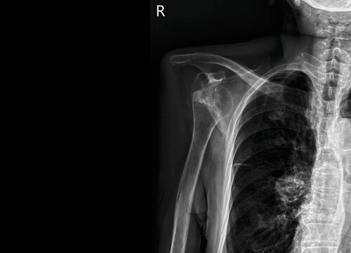 Shoulder X-ray showing humerus, scapula, clavicle and ribcage anatomy. Medical diagnostic imaging for shoulder joint evaluation, upper extremity assessment and orthopedic skeletal structure analysis.
