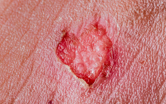 Basal cell carcinoma lesion developing on human skin