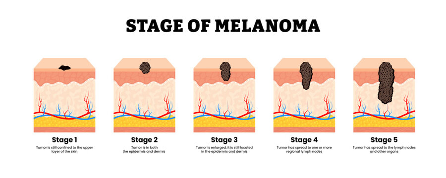 Stages of melanoma stage. The TNM classification of malignant tumors. Skin cancer metastasis. Human skin layers anatomy cross section. Vector illustration.