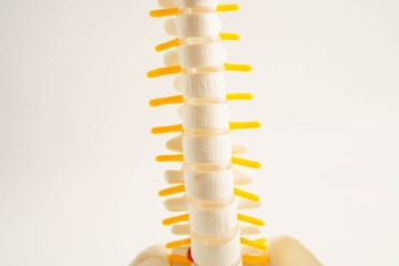 Spinal nerve and bone, Lumbar spine displaced herniated disc fragment, Model for treatment medical in the orthopedic department.