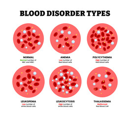 Different types of blood disorder types, Anemia, polycythemia, leukopenia,leukocytosis,thalassemia blood specimen blood composition comparison. Thrombocytes, leukocytes, erythrocytes under microscope.