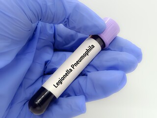 Doctor  holding a test blood sample for Legionella Pneumophila - test. Laboratory medical testing concept. . 