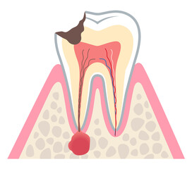 むし歯が進行し、歯の根にある神経に膿がたまった歯の断面図　根管治療