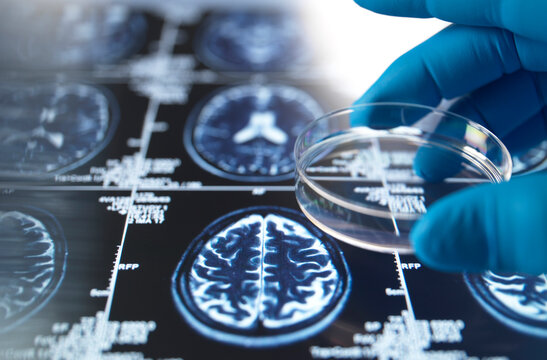Gloved hand holding petri dish over brain MRI scan for Alzheimer's research