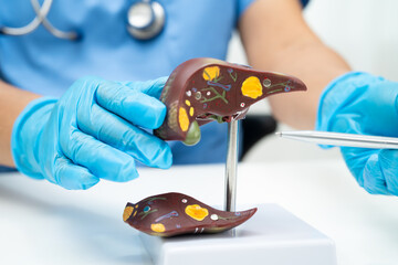 Cirrhosis, Liver cancer, fatty liver, Asian doctor with liver human anatomy model in World Hepatitis Day at hospital.