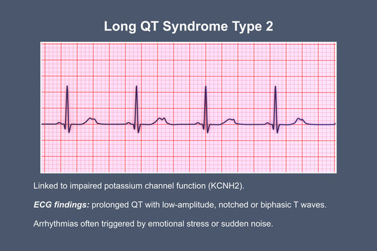 ECG in long QT syndrome type 2, 3D illustration, annotated