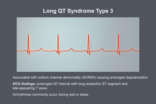 ECG in long QT syndrome type 3, 3D illustration, annotated