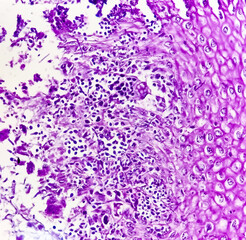Endoscopic biopsy of oesophagus, microscopically show hyperplastic oesophageal mucosa, fibrinopurulent exudate and many spores of candida. Candidiasis.