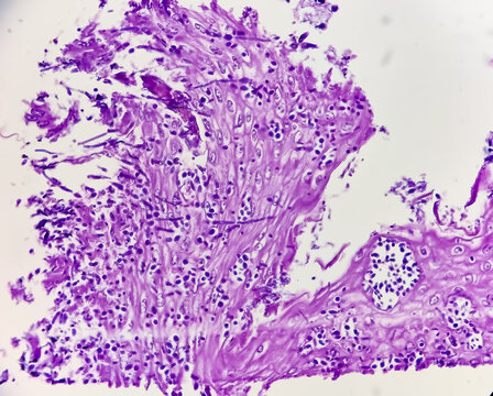 Endoscopic biopsy of oesophagus, microscopically show hyperplastic oesophageal mucosa, fibrinopurulent exudate and many spores of candida. Candidiasis.