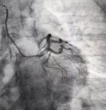 Coronary angiogram of left coronary artery during cardiac catheterization with contrast dye. Abnormal findings. Colour adjust.