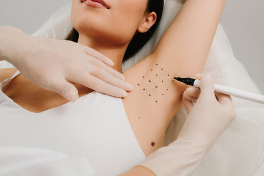 Cosmetologist is marking dotes before injecting woman armpit, closeup. Treatment of hyperhidrosis. Markup skin for hyperhidrosis treatment in the clinic.