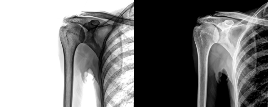 Shoulder Anterior View X-Ray Radiograph Showing Joint Bone Structure for Diagnosis of Degenerative Diseases, Injury Prediction Isolated on Transparent Background