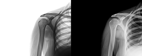 Shoulder Anterior View X-Ray Showing Glenohumeral Joint and Surrounding Soft Tissue for Diagnosis of Degenerative Disorders and Injury Prognosis Isolated on Transparent