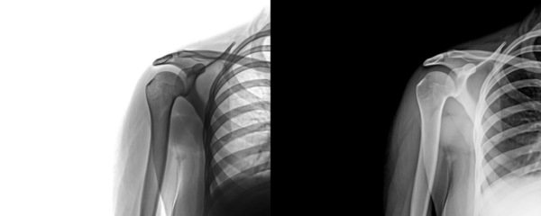 Shoulder Anterior View X-Ray Showing Glenohumeral Joint and Surrounding Soft Tissue for Diagnosis of Degenerative Disorders and Injury Prognosis Isolated on Transparent