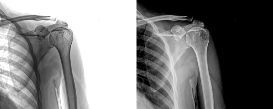 Shoulder Anterior View Radiograph Displaying Bone Anatomy for Evaluation of Degenerative Diseases and Injury Prediction Isolated on Transparent Background