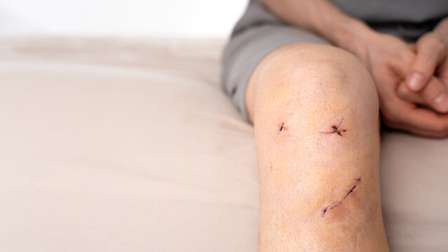 Male knee with post-surgical smile-shaped stitches after ACL ligament reconstruction, resting on soft bedding. Concept of optimistic healing, sports injury recovery, real positive post-op. Copy space