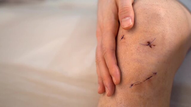 Male hand gently touches healing wound on knee with three stitched surgical incisions after ACL repair, realistic home setting. Concept of sports injury treatment, recovery and postoperative care