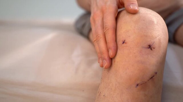 Man touches stitched knee after anterior cruciate ligament surgery, gently pressing around the healing incisions. Concept of self-monitoring, home care rehabilitation and tactile recovery assessment