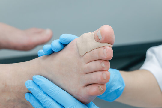 Close-up of bunion treatment on caucasian adult foot with medical bandage and gloves