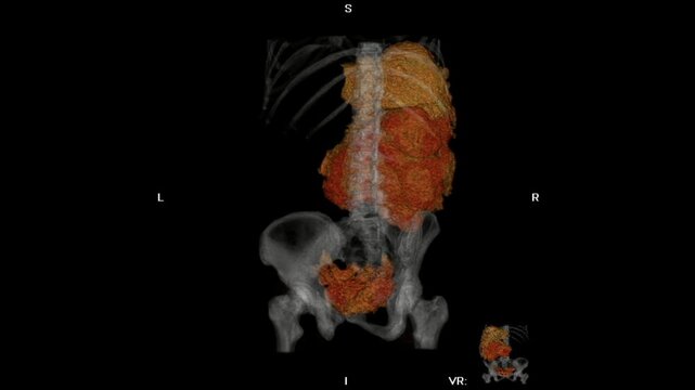 Three-dimensional CT scan reconstruction of the abdomen showing a solid mass in the kidney region, consistent with renal tumor appearance. The pelvic and vertebral bones are rendered semi-transparent 