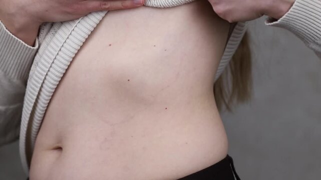 Young woman lifting her sweater to show her skin spots on the belly. Ring-shaped centrifugal erythema of Darya
