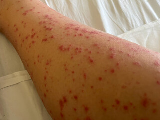 The legs of an adult woman covered with chickenpox lesions. The consequences of shingles. 