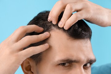 Fototapeta premium Young man with dandruff on blue background, closeup