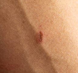 Fototapeta premium A person has a scar on their arm