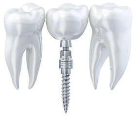 Dental teeth implant. Placement of a titanium implant into the jawbone to replace a missing tooth. Implant fixture, abutment dental crown. Oral surgery, veneers, dentistry, oral prosthesis medical PNG