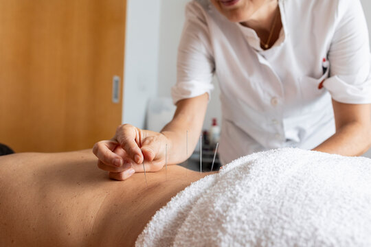 Acupuncture therapy session with needles for wellness and holistic healing