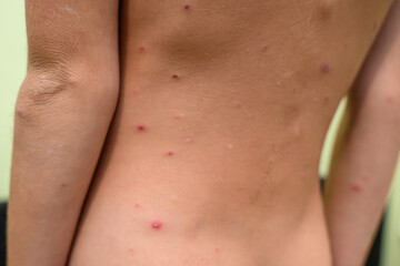 Boy with chickenpox. Rash on child body 