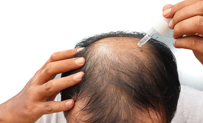 Naklejka premium An Asian man is dripping with pipette a hair nourishing serum on a thinning head area. Focus on the head