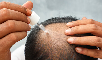 Fototapeta premium An Asian man is dripping with pipette a hair nourishing serum on a thinning head area. Focus on the head