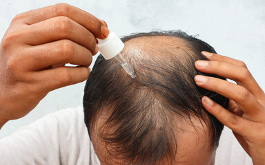 Fototapeta premium An Asian man is dripping with pipette a hair nourishing serum on a thinning head area. Focus on the head