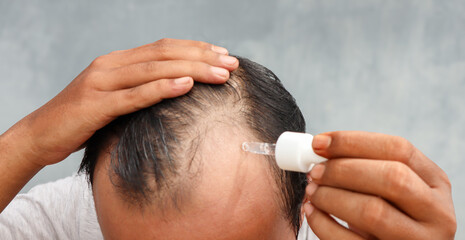 An Asian man is dripping with pipette a hair nourishing serum on a thinning head area. Focus on the head