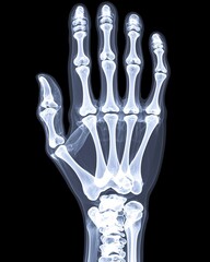Detailed X-Ray Image of a Human Hand Showing Bone Structure and Anatomy