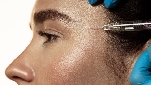 Closeup of temporal injection with fine syringe during facial rejuvenation procedure. Concept of female beauty procedures, and calm confidence in aesthetic dermatology practice.