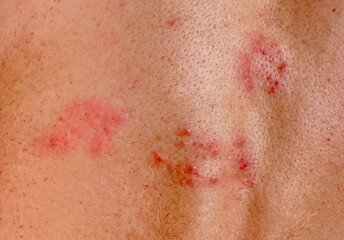 Fototapeta premium Herpes zoster infection on human skin. Skin disease background. Viral infection on human skin, acne, psoriasis, eczema, herpes, lichen, melanoma.