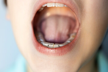 Mouth open wide showing dental appliance for orthodontic treatment in a clinical setting