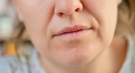 Close up of woman lips showing herpes blister caused by cold or stress. Concept of illness, health awareness, and personal hygiene.