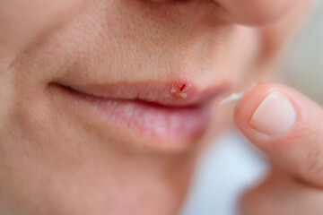 Female lips close up with cold sore. Girl uses finger to apply cream for herpes treatment. Concept of illness, care, and health protection.