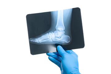 Medical professional, doctor or physician, examining human foot x-ray for diagnosis of injury, fracture, medical condition