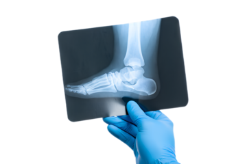 Medical professional, doctor or physician, examining human foot x-ray for diagnosis of injury, fracture, medical condition
